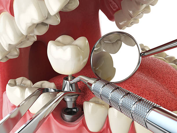 Best Emergency Dentist for Lost Fillings or Crowns in Ina, IL